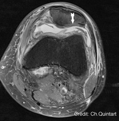 dr quintart Ch IOR-G1:cellules souches msenchymateuses:rotule: mesenchymal stem cells:patella:postop