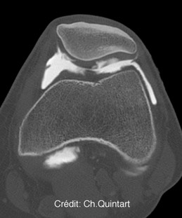 IOR-G1 dr Christian Quintart: cellules souches msenchymateuses:rotule: mesenchymal stem cells:patella:prop